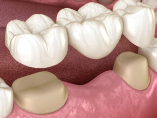 https://www.stefanoudentalclinic.gr/wp-content/uploads/2025/06/γέφυρα-δοντιών-1-320x240.jpg