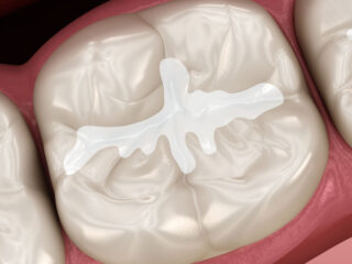 https://www.stefanoudentalclinic.gr/wp-content/uploads/2025/06/εμφραξη-ρητινης-2-320x240.jpg