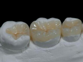 https://www.stefanoudentalclinic.gr/wp-content/uploads/2025/06/επενθετα-320x240.jpg