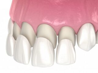 https://www.stefanoudentalclinic.gr/wp-content/uploads/2025/06/οψεις-πορσελανης-3-320x240.jpg