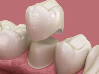 https://www.stefanoudentalclinic.gr/wp-content/uploads/2025/06/στεφανη-ολικης-καλυψης-320x240.jpg